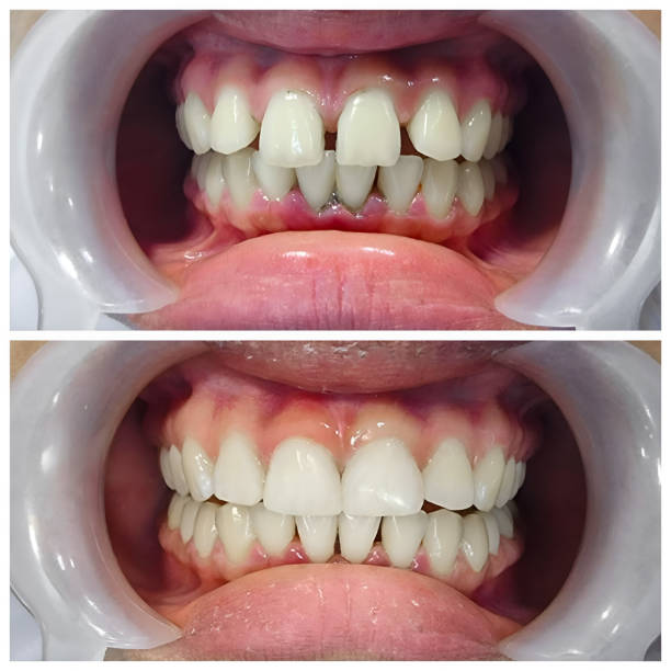 Full Mouth Reconstruction in Bloomfield, NY